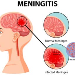 Diagram of the brain with meningitis