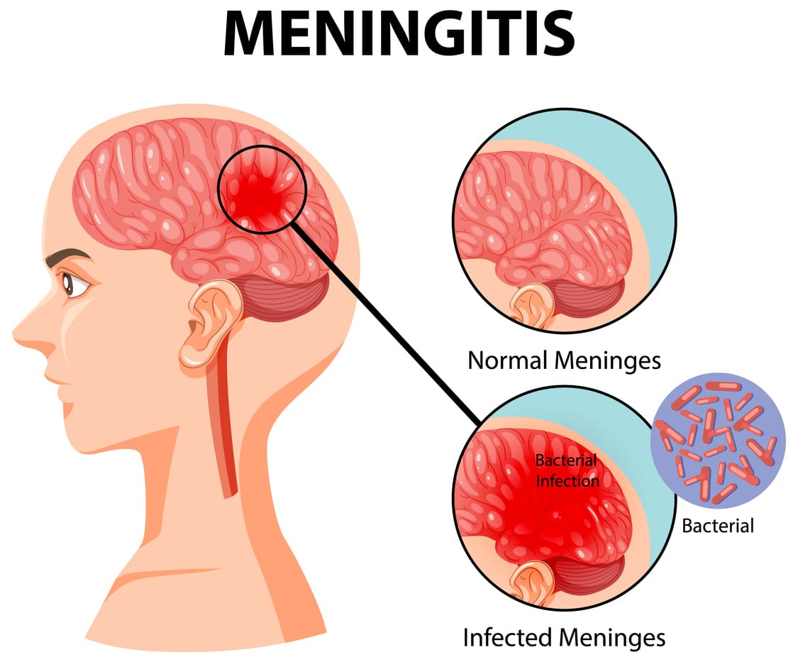 Diagram of the brain with meningitis.